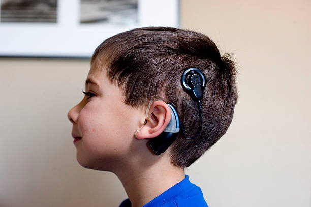 cochlear-implants
